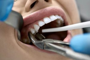 Wisdom Tooth Extraction Newmarket