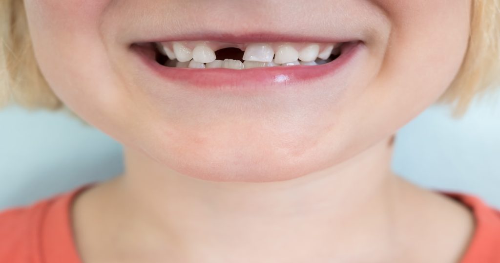 Find the Perfect Solution for Missing Teeth