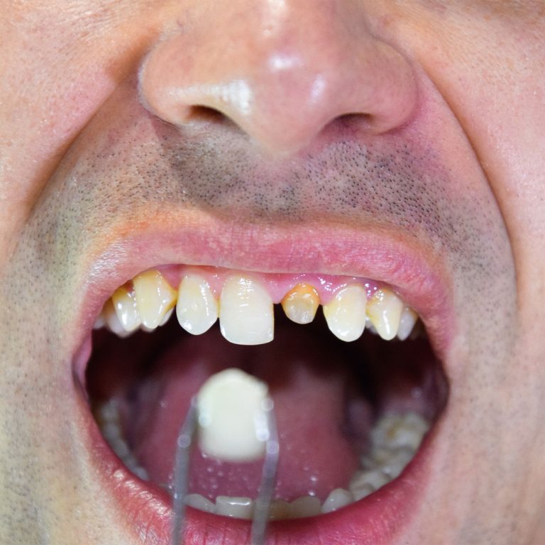 Broken or chipped tooth