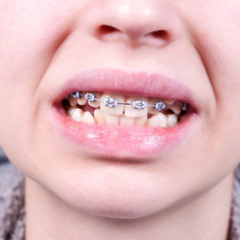 Broken braces or orthodontic appliance