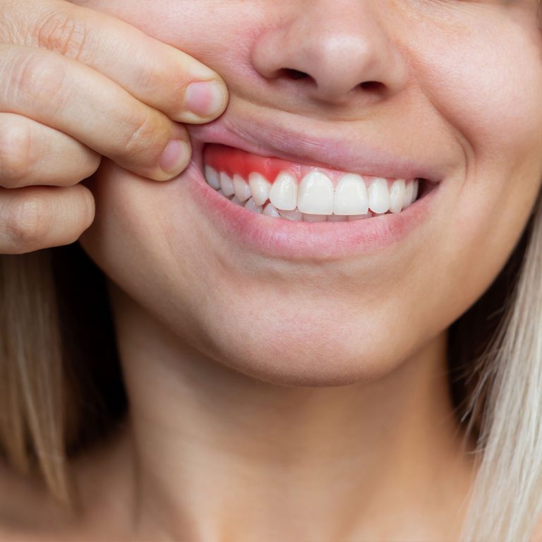 Care for a broken or chipped tooth