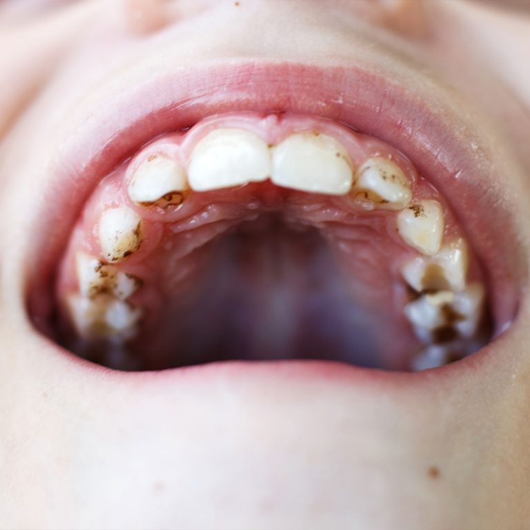 Dental swelling or suspected infection