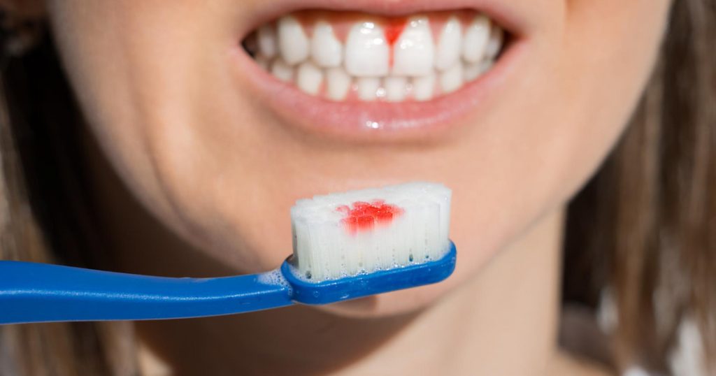Manage Bleeding Gums