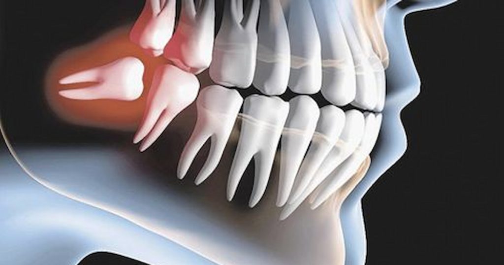 wisdom tooth removal