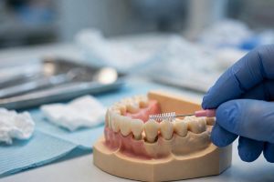 Cleaning under a dental bridge with an interdental brush